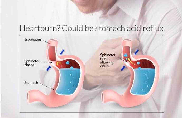 what causes heartburn ?